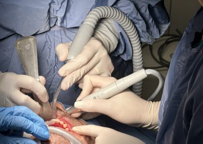 Ablazione del tartaro con ultrasuoni