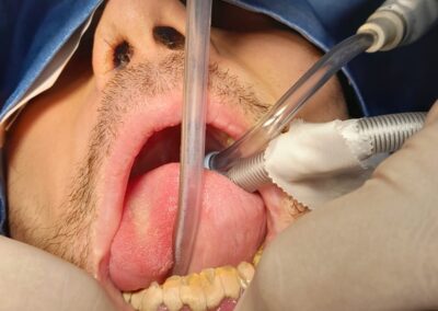 Paziente con abbondante tartaro in anestesia generale con intubazione dalla bocca e doppio aspiratore chirurgico