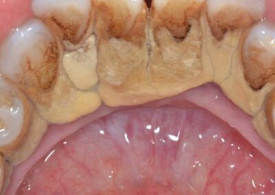 Muraglia di tartaro sulla superficie linguale degli incisivi inferiori