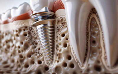 Cortisone Osteoporosi e Impianti Dentali: la Complessità delle Cure Dentali