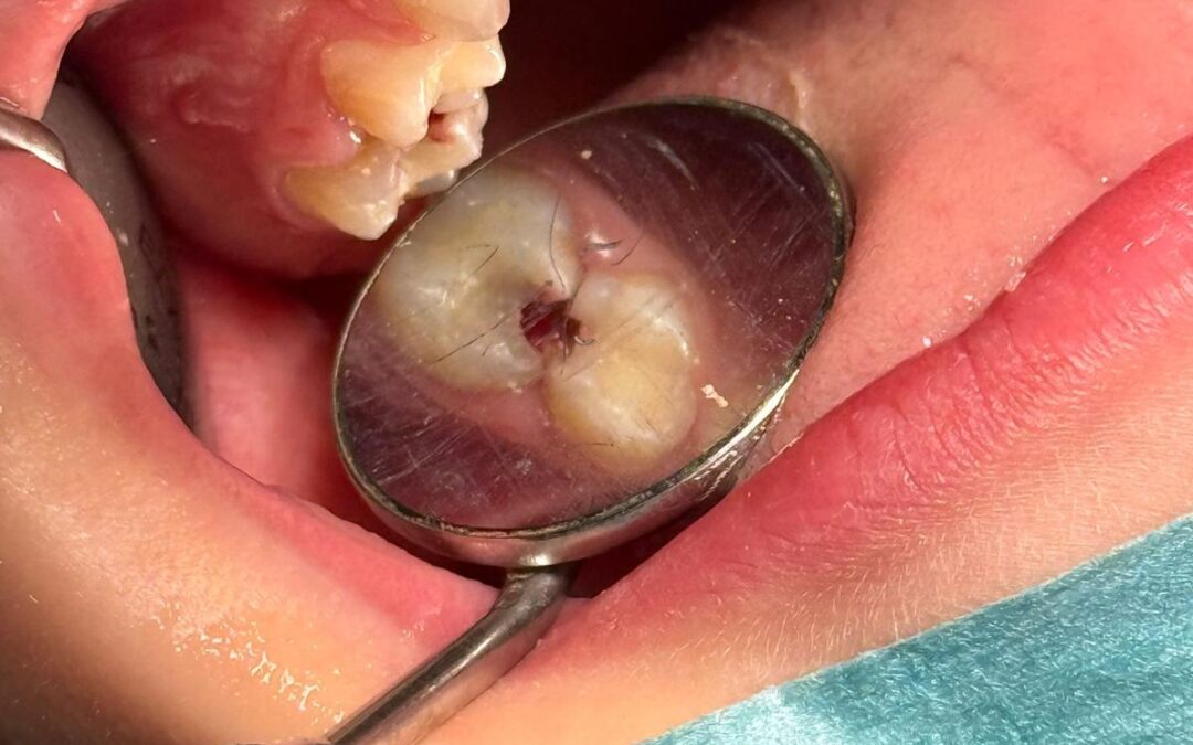 Cure Dentali per Bambini molto Piccoli, a Torino