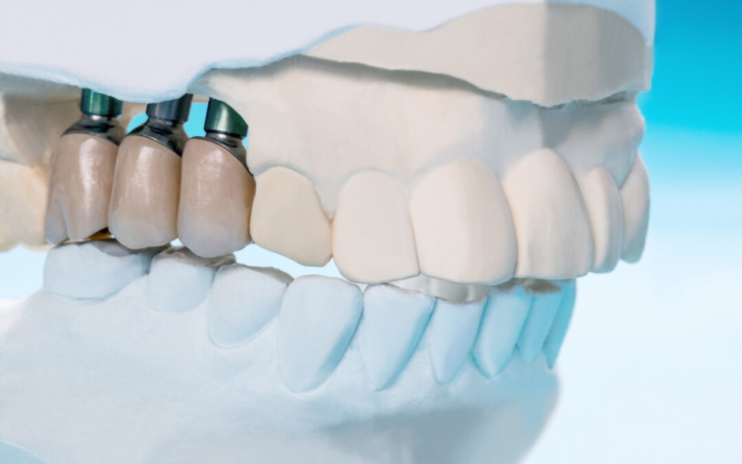 Denti Fissi in 24 Ore con Anestesita Totale a Roma e Milano