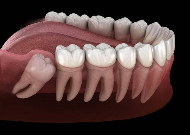Estrarre i Denti del Giudizio in Anestesia Totale
