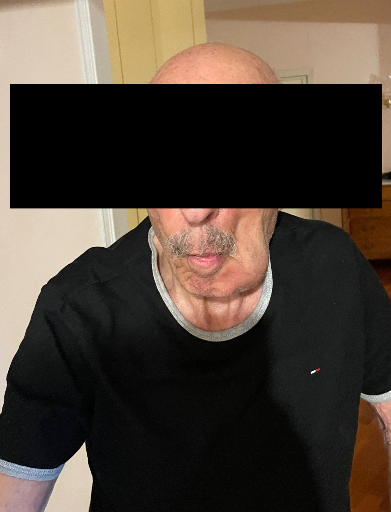 Ascesso Odontogeno in Paziente con Malattia di Alzheimer